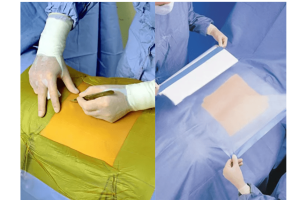 INCISE FILM DRESSING / I-O CURE DRESSING